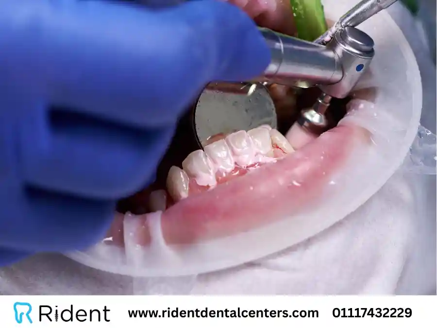 كم سعر تنظيف الاسنان في السعودية؟ وأهم نصائح العناية بها